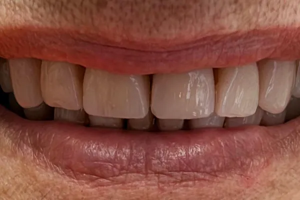 Dopo il trattamento: denti anteriori ricostruiti in composito, senza spazio tra gli incisivi centrali.