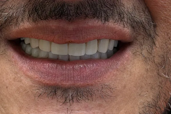 Dopo il trattamento: sorriso con le protesi fisse su impianti nelle due arcate.